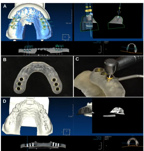 Fig. 3. Planning and insertion of implant. (A) Planning on position and angulation of the implant, (B) CT guided implant template, (C) Drilling through the implant tem- tem-plate with a drill, (D) Post-surgical cone beam-CT image.