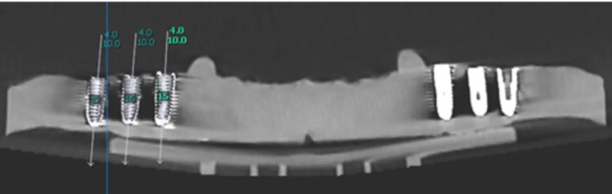 Fig. 5. Deviation between virtually planned and actually placed implant. (A) Center of prosthetic platform of implant, and apex refers to center of tip of implant, (B) Deviation between virtually planned and actually placed implant is illustrated for platf