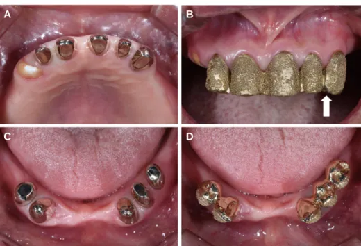 Fig. 8. Inner crown and outer crown try-in. (A) Maxillary inner crown try-in, (B) Maxillary outer crown try-in