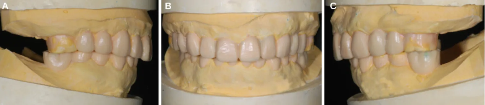 Fig. 3. Direct resin filling.