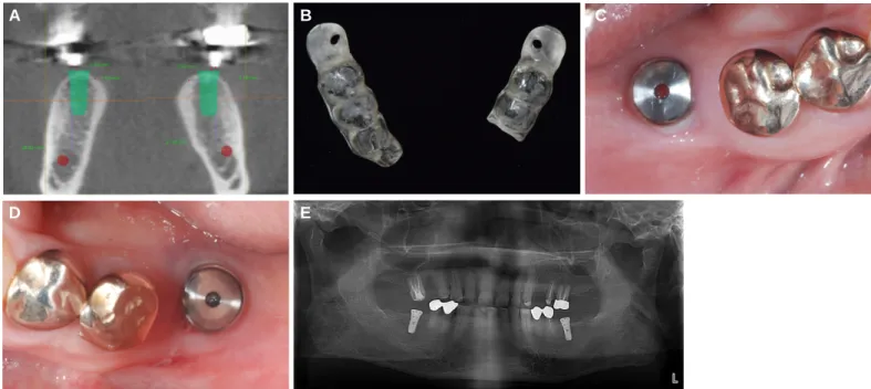 Fig. 4. Flapless implant surgery. (A) Cone beam computed tomography, (B) Surgical Stent, (C, D) Two implants were placed in the lower jaw, (E) Panoramic radiograph after implant placement.