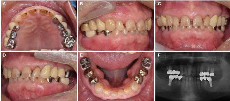 Fig. 7. Five months check-up after delivery of final restorations. (A) Maxillary occlusal view, (B) Right lateral view, (C) Frontal view, (D) Left lateral view, (E) Mandibular occlusal view, (F) Panoramic radiograph.
