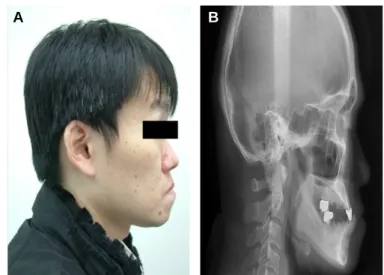 Fig. 3. (A) Initial lateral view of face, (B) Initial lateral cephalometric radiograph.