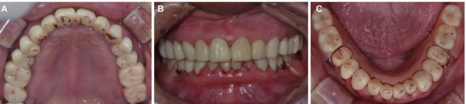 Fig. 5. Provisional restoration. (A) upper, (B) frontal, (C) lower.