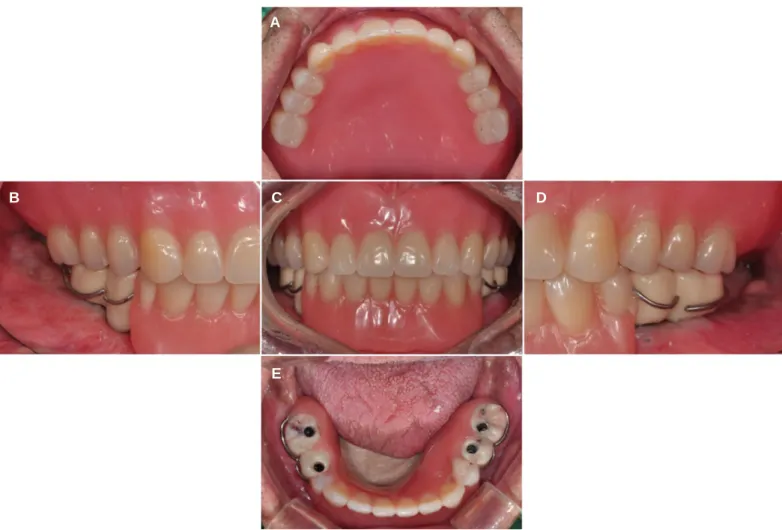 Fig. 5. Surveyed bridges and RPD framework (A) Surveyed bridges, (B) RPD framework (Occlusal view), (C) RPD framework (Frontal view).