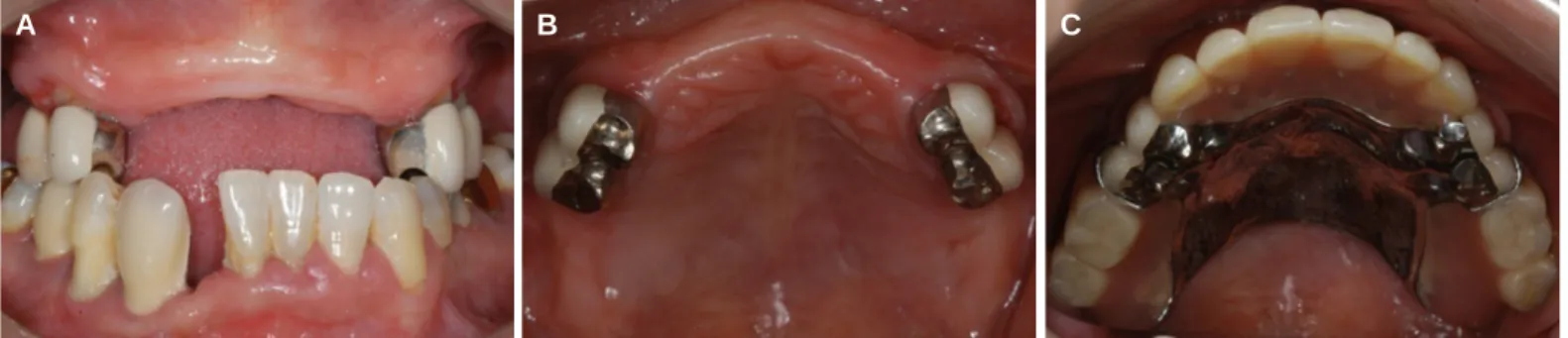 Fig. 1. Pretreament intraoral view. (A) frontal view, (B) upper occlusal view (C) upper occlusal view with old RPD.