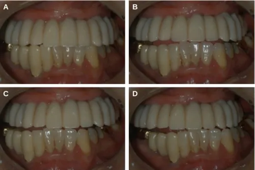 Fig. 3. Screw retained interim implant prosthesis. (A) Maximum intercuspation, (B) Protrusive movement, (C) Right lateral movement, (D) Left lateral movement.