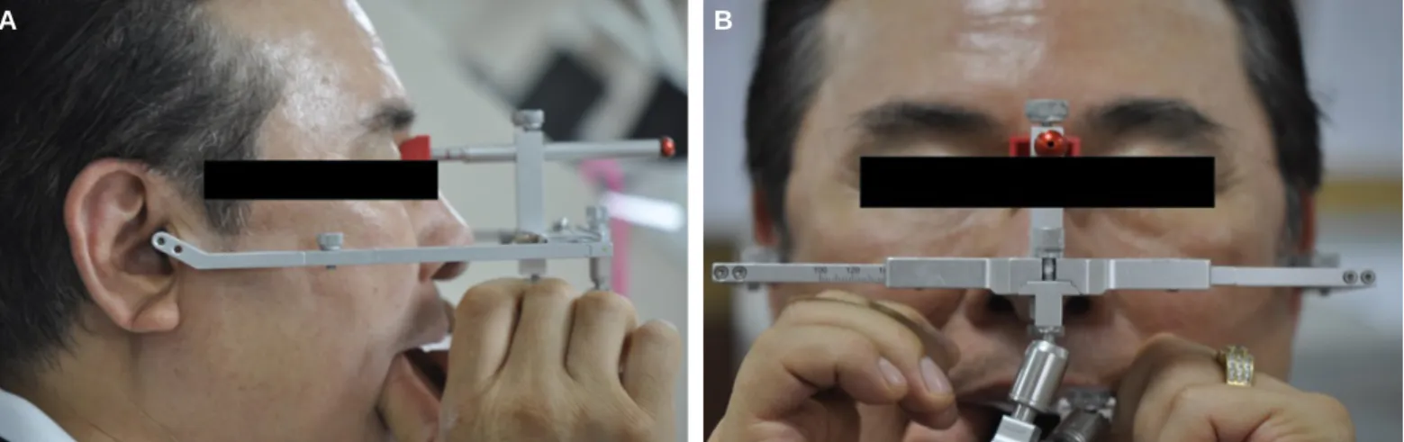 Fig. 4. Face-bow transfer. (A) Right side view, (B) Frontal view.