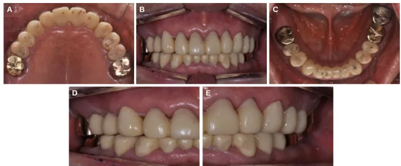 Fig. 6. Provisional restorations. (A) Maxillary occlusal view, (B) Frontal view, (C) Mandibular occlusal view, (D) Right side view, (E) Left side view.