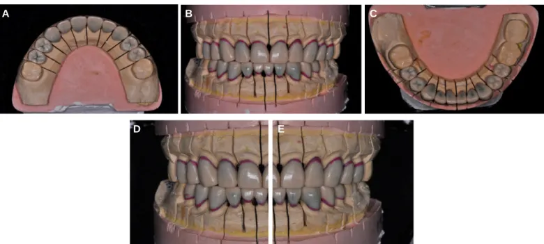 Fig. 9. Full contour wax up. (A) Maxillary occlusal view, (B) Frontal view, (C) Mandibular occlusal view, (D) Right side view, (E) Left side view.