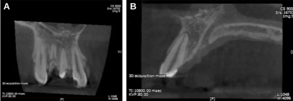 Fig. 3. (A) Healing of the extraction sockets 8 weeks after removing teeth #11 and #12, (B) Essix retainer.