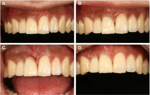 Fig. 8. (A) 6 weeks after temporary bridge delivery, (B) 8 weeks after temporary bridge delivery, (C) 10 weeks after temporary bridge delivery and gingivectomy, (D) 14 weeks after temporary bridge delivery.