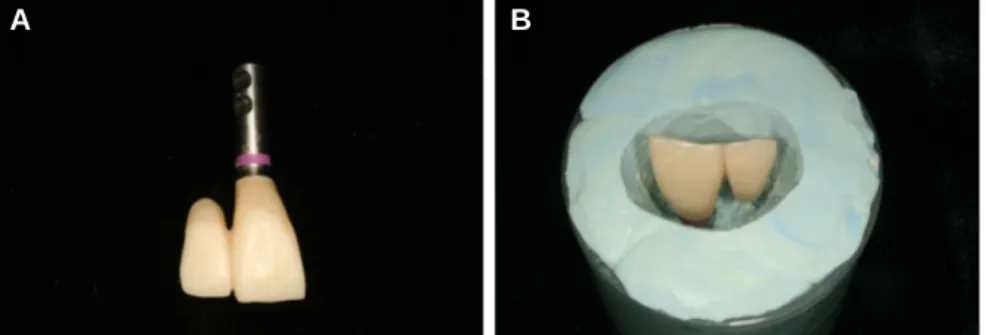 Fig. 9. (A) The temporary restoration, (B) Silicone index of the cervical area of the temporary restoration.
