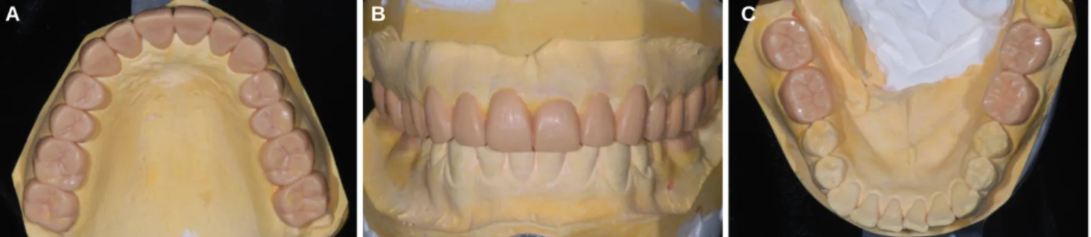 Fig. 4. Diagnostic wax up. (A) Maxillary occlusal view, (B) Frontal view, (C) Mandibular occlusal view.