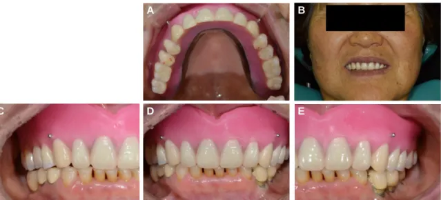 Fig. 7. Wax denture try-in. (A) Occlusal view of maxilla, (B) Extraoral view, (C) Right lateral view, (D) Frontal view, (E) Left lateral view.