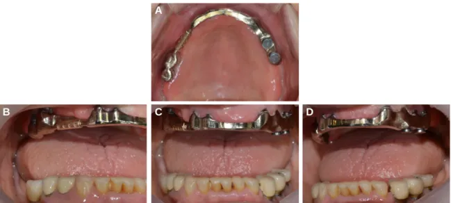 Fig. 8. Cementation of bar. (A) Occlusal view of maxilla, (B) Right lateral view (C) Frontal view, (D) Left lateral view.