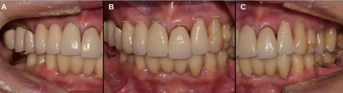Fig. 4. Old prosthesis and generalized gingival recession in initial panoramic radiograph.