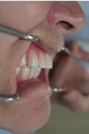 Fig. 1. Frontal view of fully edentulous mouth of the patient. Fig. 2. Class II jaw relationship of old denture (Lateral view).