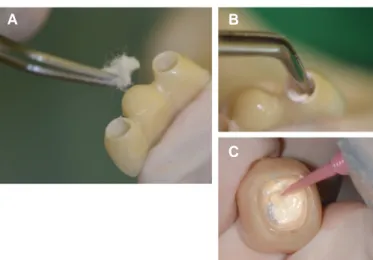 Fig. 3. Half filling technique. (A) Petroleum jelly was applied on the outer surface of prosthesis, (B) Small amounts of cement were applied on the occlusal half with the pincette, (C) Small tip brush also can be used in half filling technique.