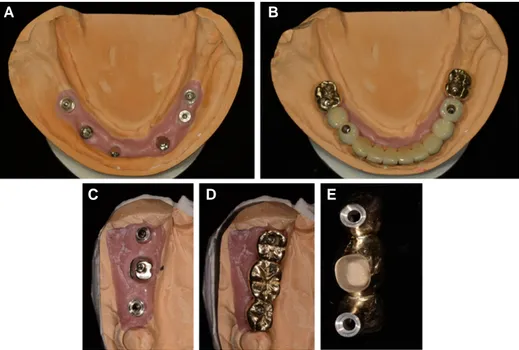 Fig. 5. SCP prosthesis. (A) Customized abutments were connected to anterior implants, (B) Definitive SCP prosthesis, (C) Customized abutment was connected to middle implant, (D) Definitive SCP prosthesis, (E) Note the middle conventional crown connected wi