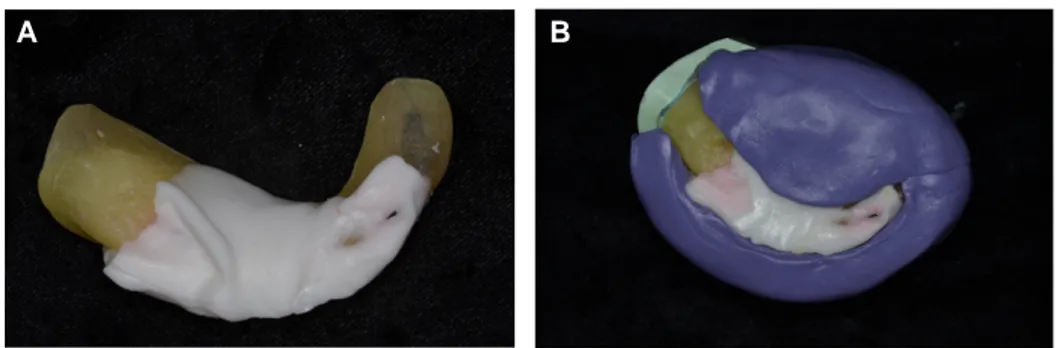Fig. 9. Wax denture. (A) Maxillary waxed up denture with two rows of teeth, (B) Mandibular wax denture, (C) Denture teeth physiologically arranged within neutral zone space.