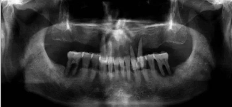 Fig. 1. Panoramic view shows residual dentition and bone loss due to advanced periodontal disease.