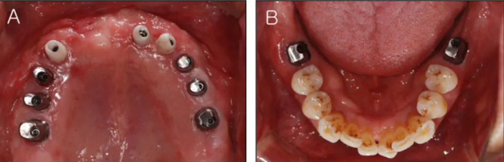 Fig. 8. Try-in of zirconia framework was performed. (A) Upper occlusal view, (B) Lower occlusal view