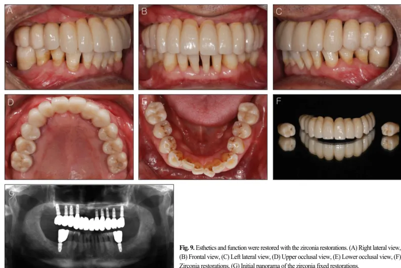 Fig. 9. Esthetics and function were restored with the zirconia restorations. (A) Right lateral view, (B) Frontal view, (C) Left lateral view, (D) Upper occlusal view, (E) Lower occlusal view, (F) Zirconia restorations, (G) Initial panorama of the zirconia 