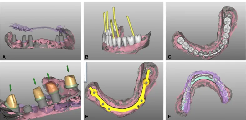 Fig. 3. Laboratory procedures using 3Shape software. (A) Scanned customized abutments (Gray), gingiva (Pink) and bite material of antagonistic teeth (Purple), (B) Confirmation of fixture and hole direction, (C) Mandibular teeth arrangement according to the