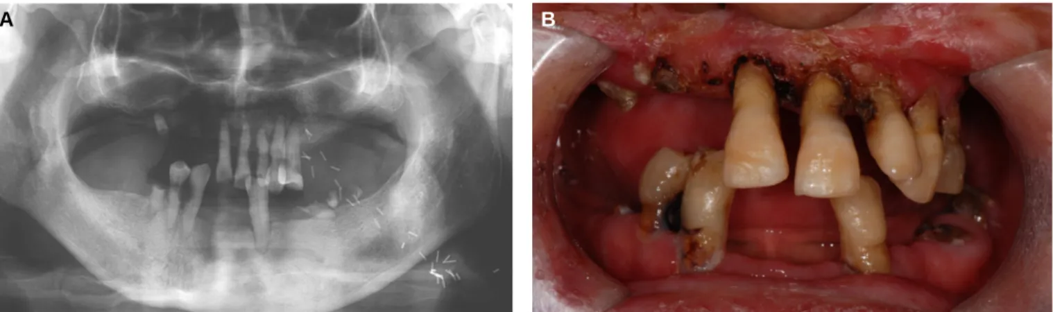 Fig. 2. Maxillary impression with conventional method.