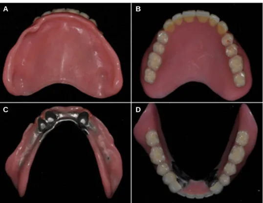 Fig. 5. (A, B) Maxillary complete denture, (C, D) mandibular double crown RPD.