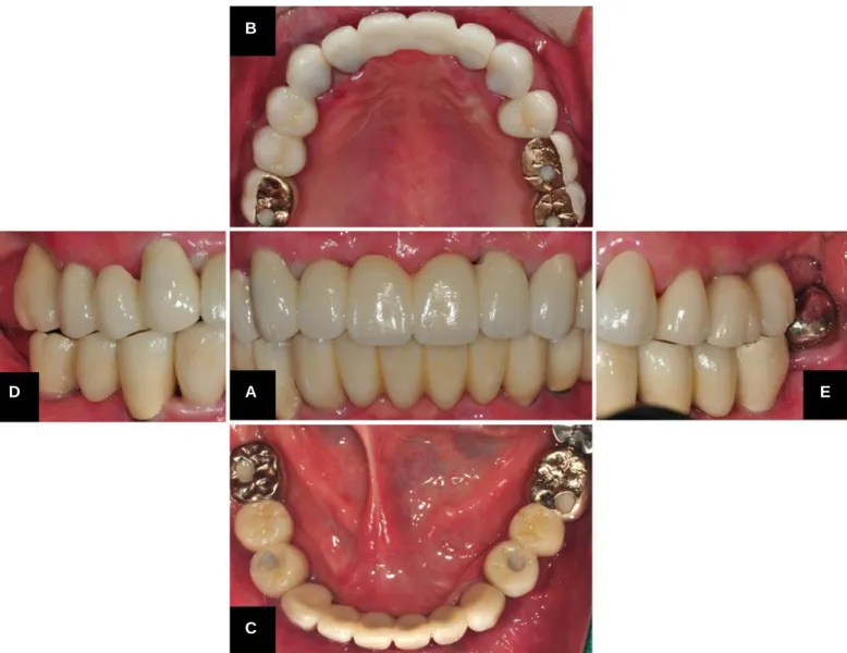 Fig. 2. Postoperative intraoral view. (A) Frontal view, (B, C) Occlusal view, (D, E) Buccal view.