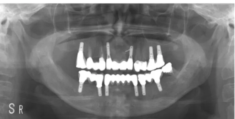 Fig. 3. Panoramic radiograph 18 months after placement of definitive prosthesis.