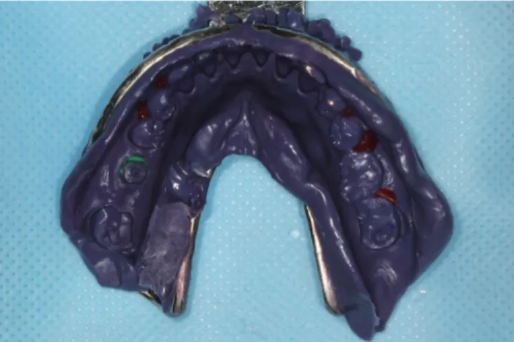 Fig. 2. Transfer type impression using healing abutment.