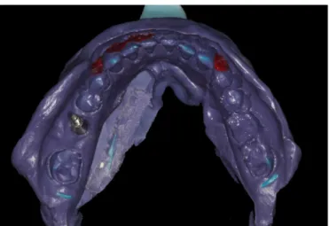 Fig. 5. Superimposed images of two scan images. Fig. 6. Analysis of difference between the two virtual models (impression healing abutment used / impression coping used).
