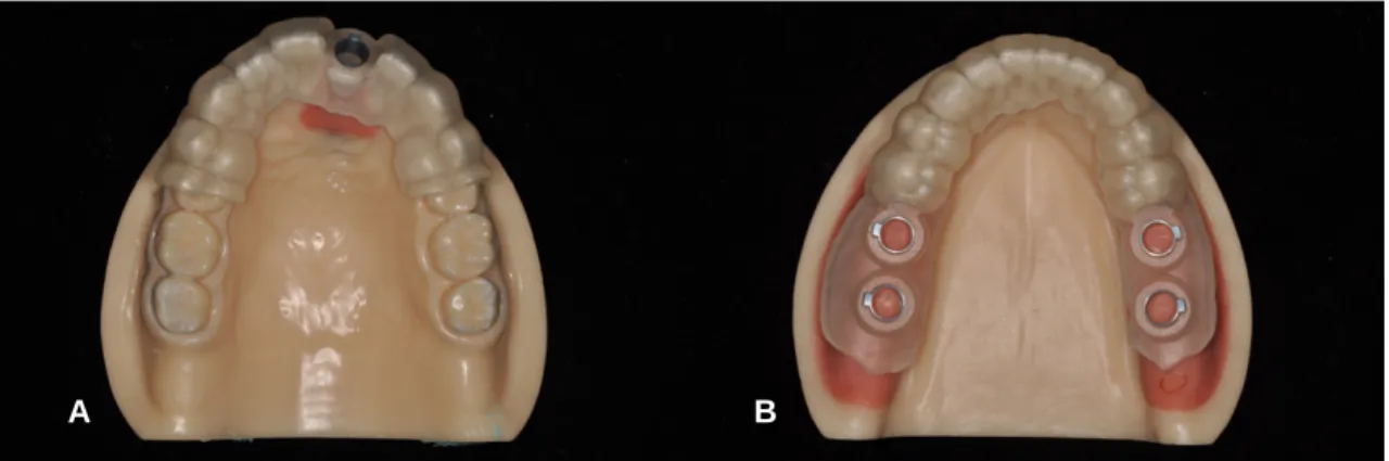 Fig. 6. The merged image of the CBCT scan and the intraoral scan.