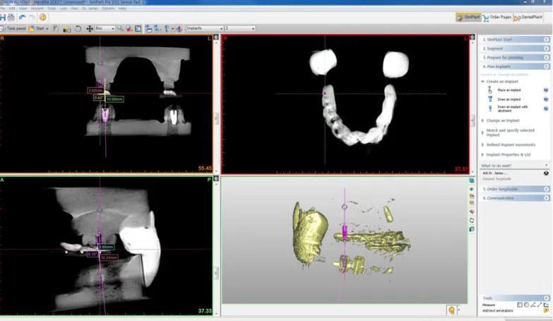 Fig. 15. Position and angulation of the implant on the Simplant software.