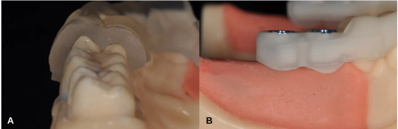 Fig. 16. Surgical guides on the resin maxilla (A) and mandible models (B).