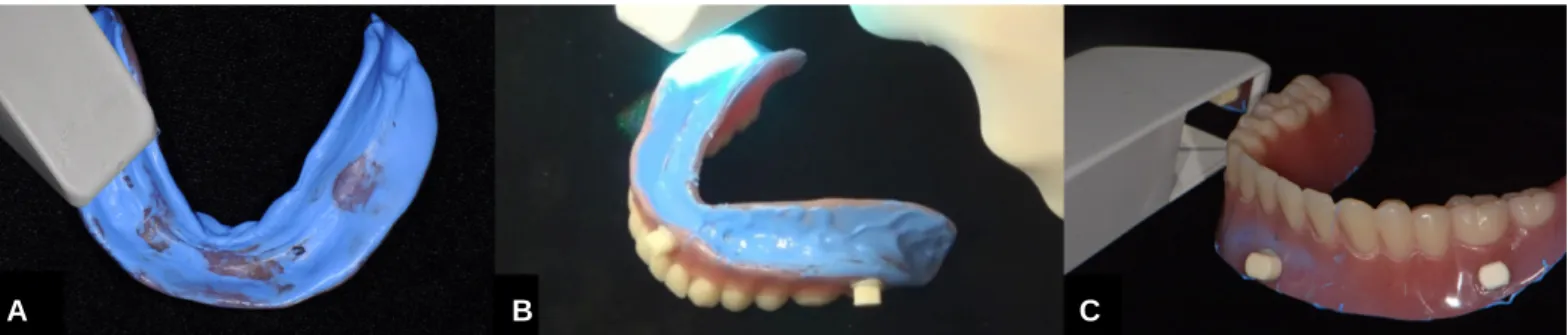 Fig. 3. Scanning of the denture, including the denture base, teeth and markers. (A) Scanning the denture base, (B) Scanning the marker and edge of denture base, (C) Scanning the denture teeth and marker.