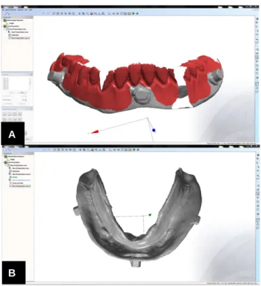 Fig. 5. Digital images of the denture and the opposing teeth with interocclusal relationship.