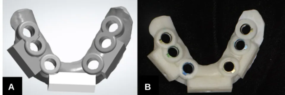 Fig. 10. Surgical guide designed and printed. (A) The surgical guide designed by computer software, (B) The surgical guide fabricated by 3D printer.