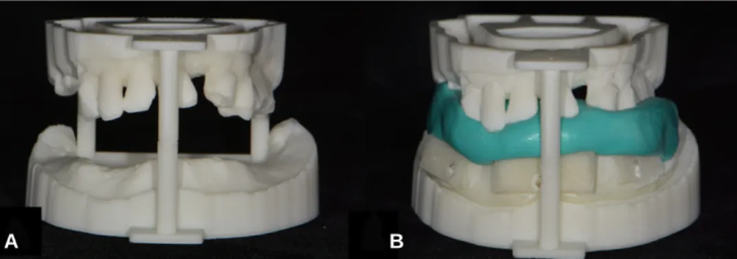 Fig. 13. Surgical guide fixed in place with three stabilization screws (A) and the condition immediately after implant placement (B).