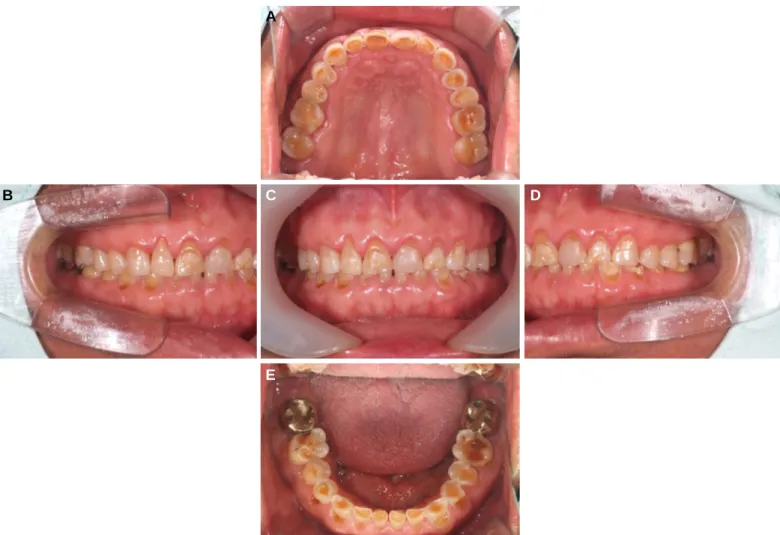 Fig. 1. Initial intraoral view. (A) Maxillary occlusal view, (B) Right lateral view, (C) Frontal view, (D) Left lateral view, (E) Mandibular occlusal view.
