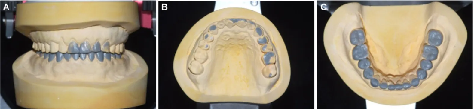 Fig. 2. Diagnostic wax up. (A) Frontal view, (B) Maxillary occlusal view, (C) Mandibular occlusal view.