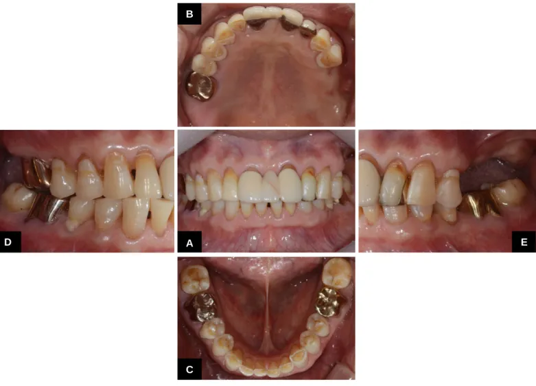 Fig. 2. Postoperative intraoral view. (A) Frontal view, (B, C) Occlusal view, (D, E) Buccal view.