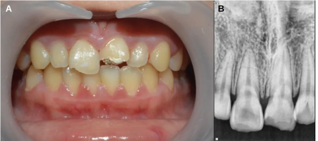 Fig. 1. (A) Initial intraoral view, (B) Initial periapical radiograph.