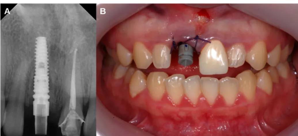 Fig. 2. (A) Periapical radiograph of scanpost (RaphaBio, Seoul, Korea), (B) Scanbody (Sirona, Bensheim,Germany) adaptation for digital impression.