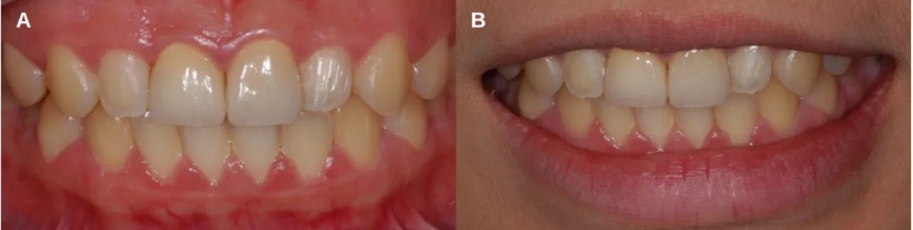 Fig. 6. Initial periapical radiograph. Fig. 7. Scanbody (Dio, Busan, Korea) adaptation for digital impression.