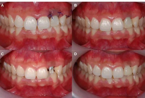 Fig. 9. (A) Delivered provisional abutment and temporary crown, (B) After stich out, (C) Delivered customized zirconia abutment, (D) Temporary crown on the abutment.