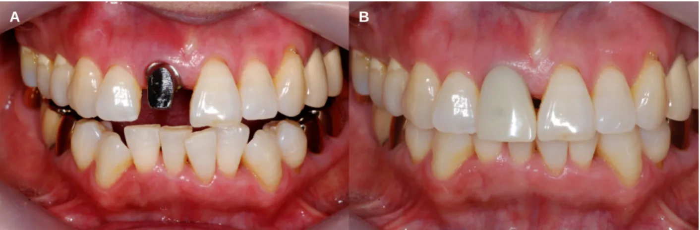 Fig. 14. (A) Delivered temporary titanium abutment, (B) Temporary crown on the abutment.